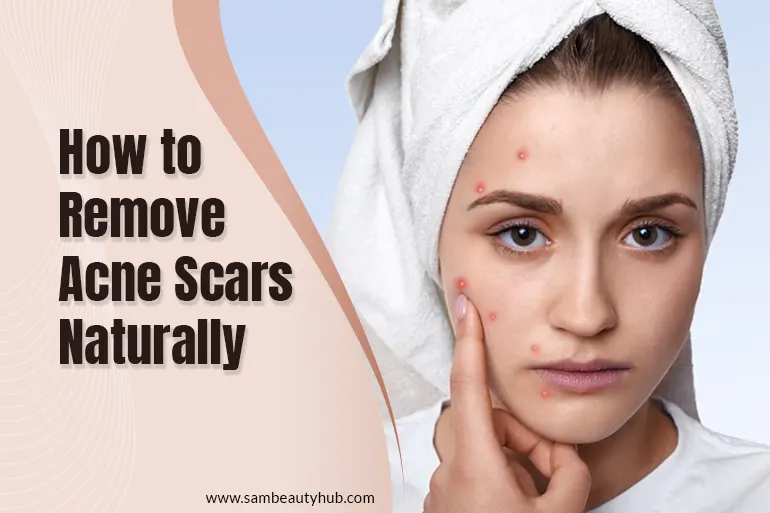 How to Remove Acne Scars Naturally