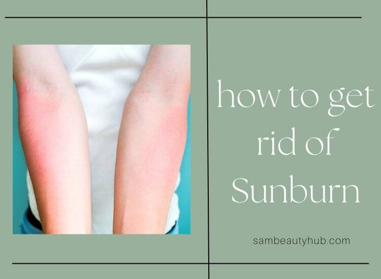 how to get rid of Sunburn